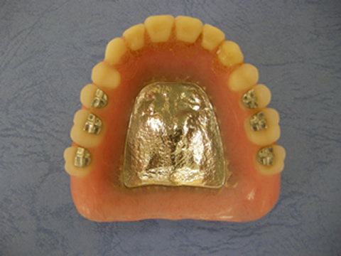 差し歯・入れ歯